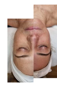 hydracare kezelés eredménye